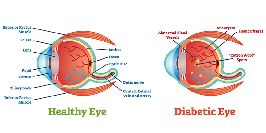 what-is-diabetic-retinopathy-the-eye-center-of-north-florida